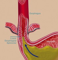 Gastroesophageal reflux disease (GERD)  model 2